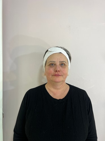 Paciente depois da harmonização facial - lado direito